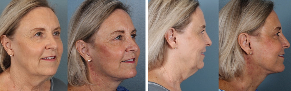 Deep plane facelift