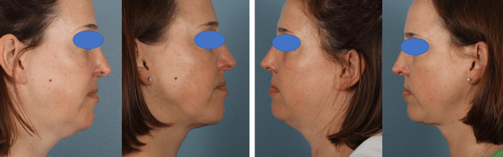 Laser Lipo