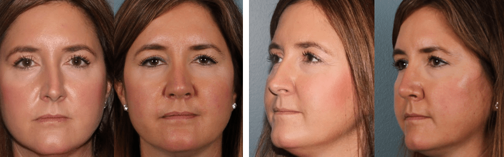 Open Rhinoplasty