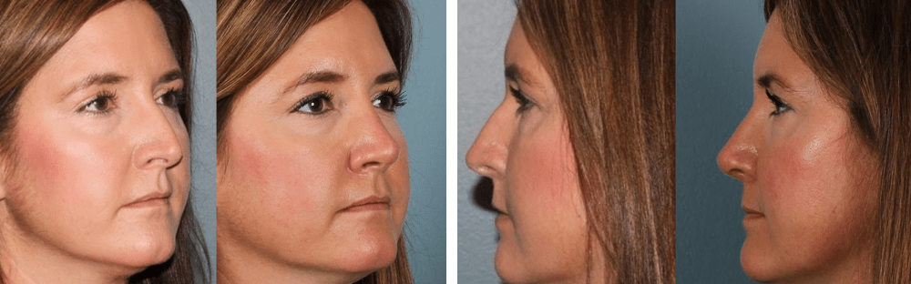 Open Rhinoplasty