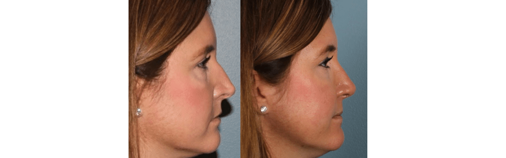 Open Rhinoplasty