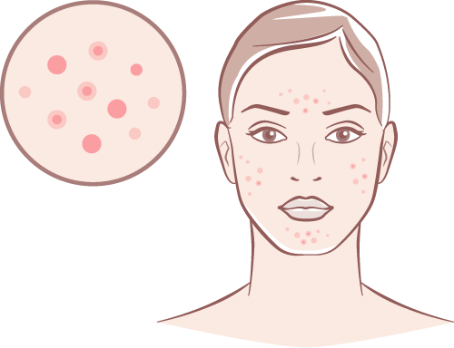 Skin Growths