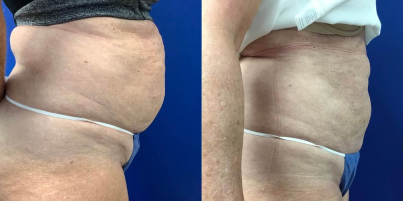 Before & After