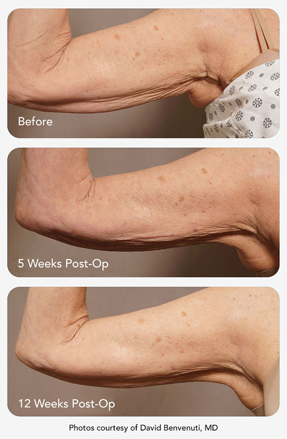 plasma skin tightening