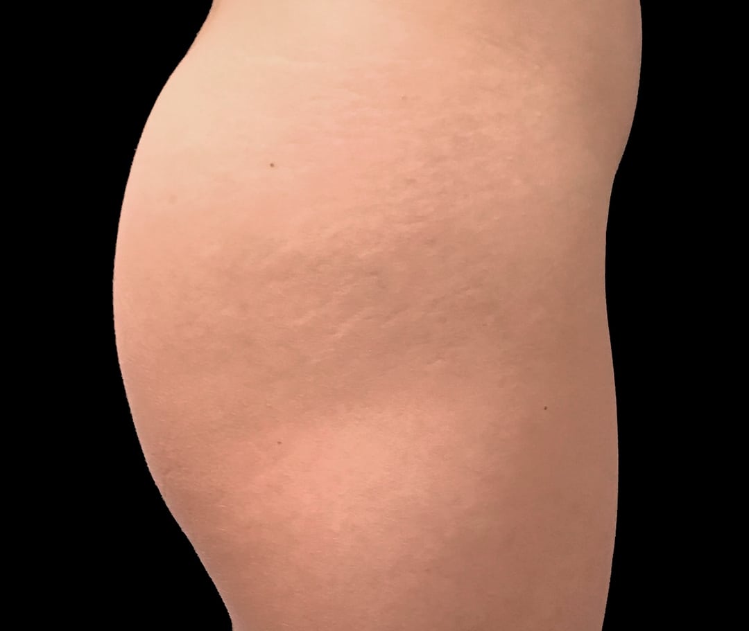 Buttocks Enhancement Before & After Photos - Upper East Side New York, NY