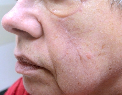 Before & After Photos Mohs Surgery Scalp | NYC