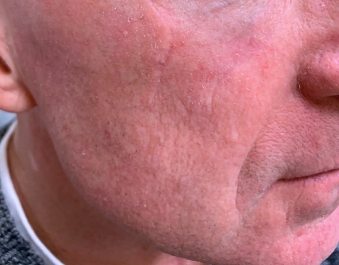 Before & After Photos Mohs Surgery Scalp | NYC