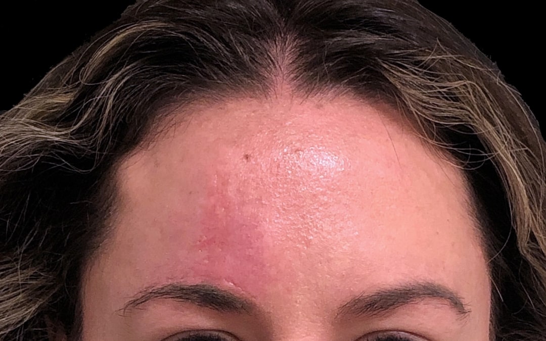 Before & After Photos Mohs Surgery Forehead 6 NYC