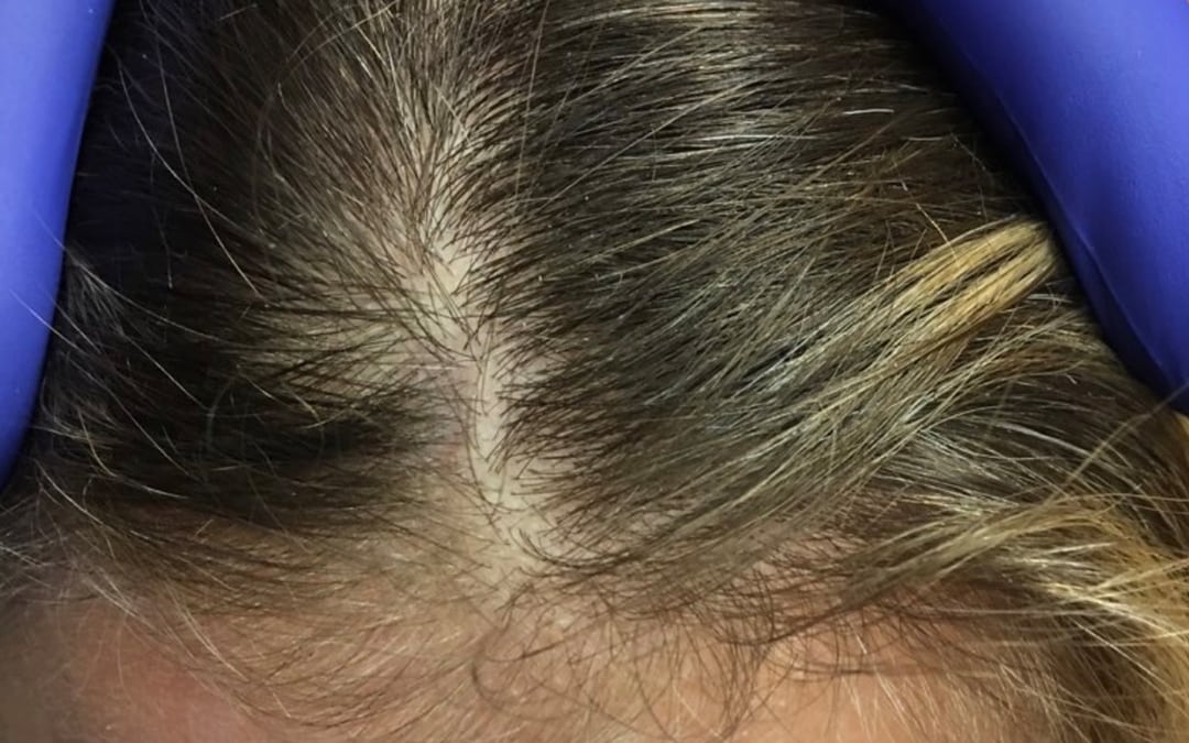 Before & After Photos Mohs Surgery Scalp 3 | NYC