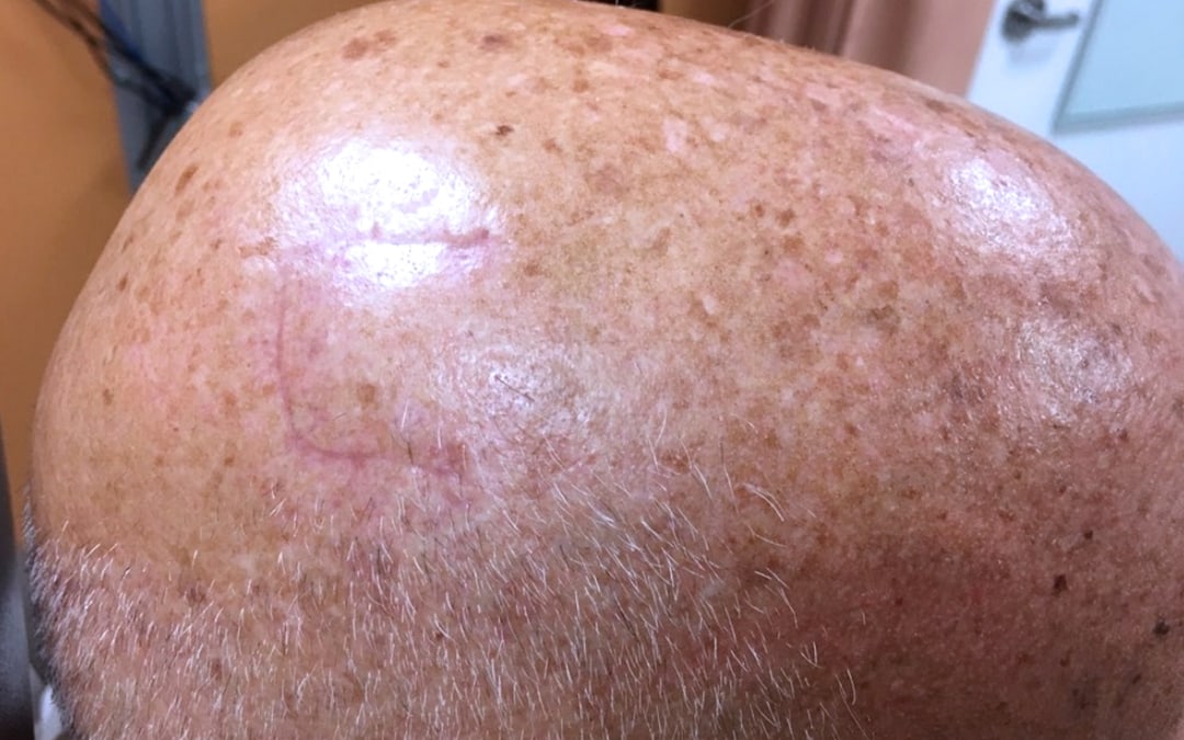 Before & After Photos Mohs Surgery Scalp 3 | NYC