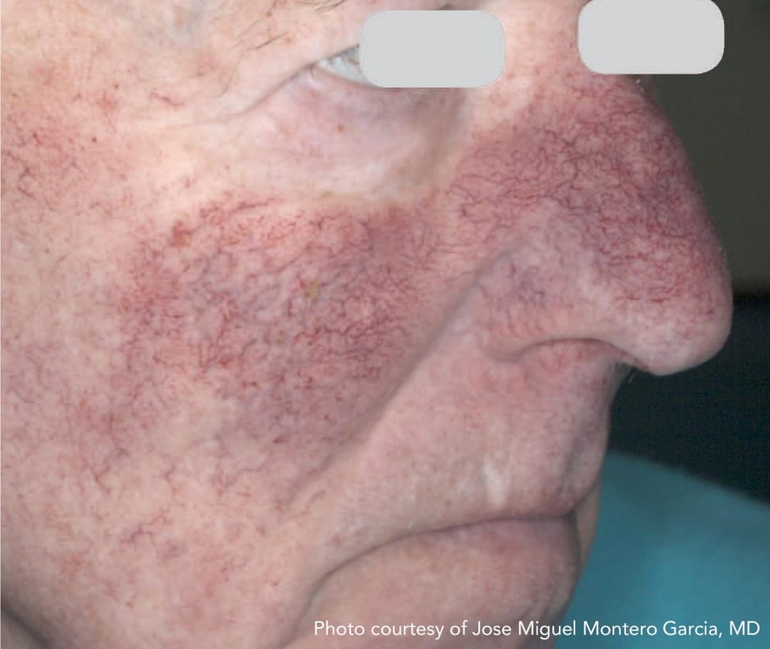 Vascular Lasers for Redness & Veins Before & After Photos Upper East