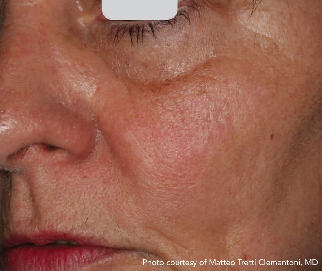 Before & After Photos Vascular Lasers for Redness & Veins Vbeam NYC