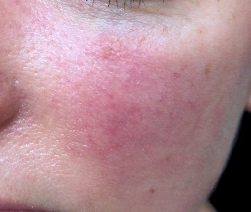 Before & After Photos Vascular Lasers for Redness & Veins Vbeam NYC