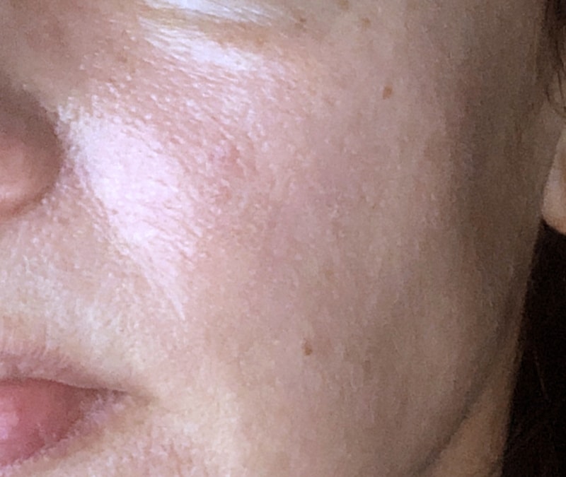 Before & After Photos Vascular Lasers for Redness & Veins Vbeam NYC