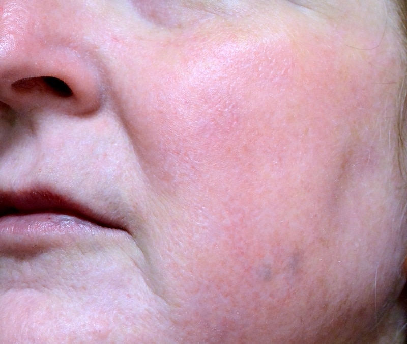 Vascular Lasers for Redness & Veins Before & After Photos Upper East