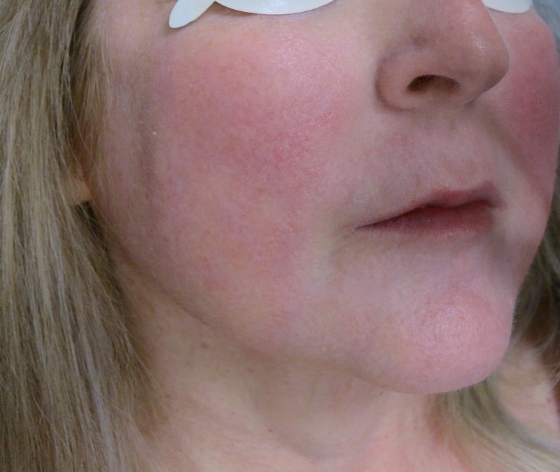 Vascular Lasers for Redness & Veins Before & After Photos Upper East