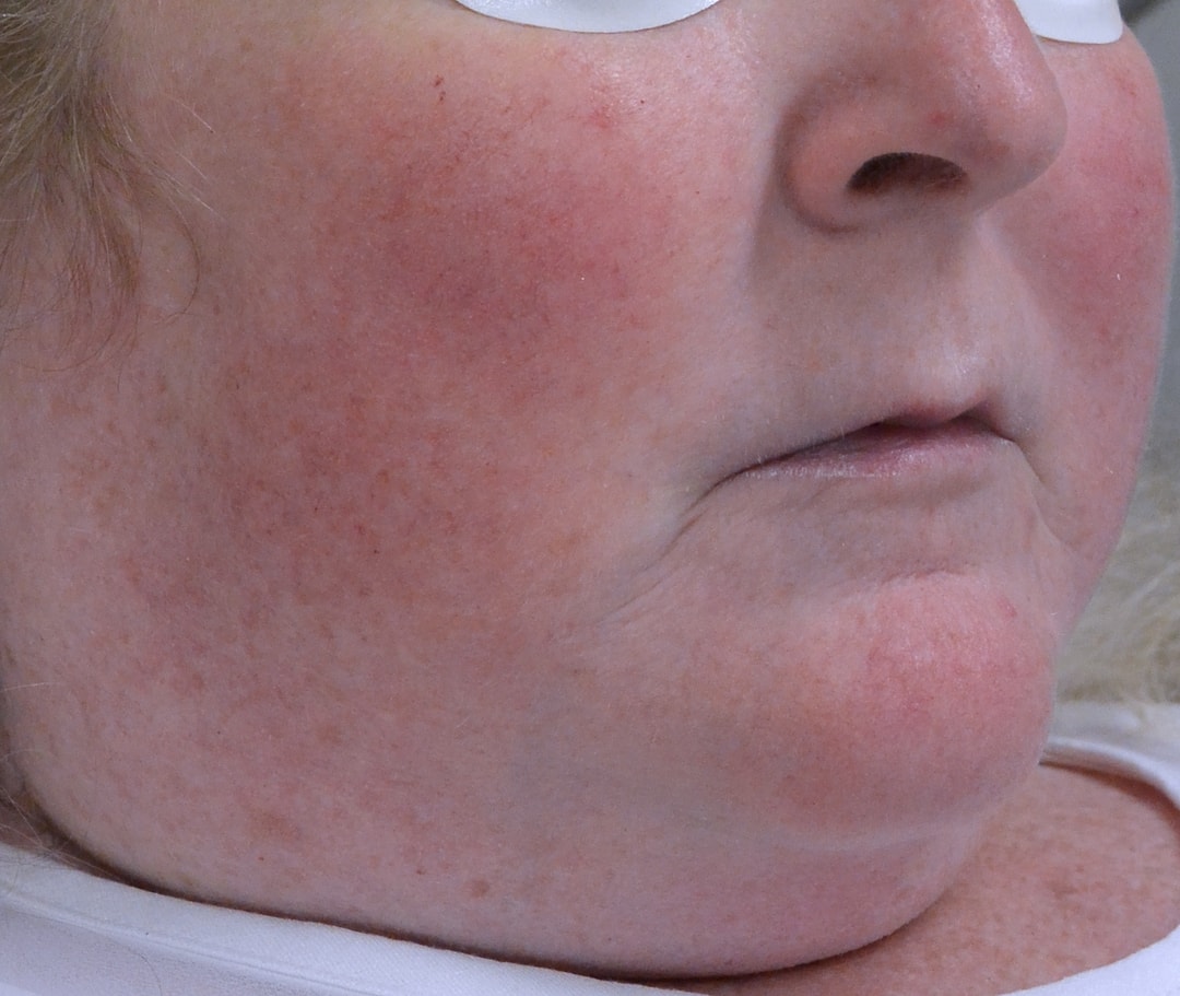 Vascular Lasers for Redness & Veins Before & After Photos Upper East