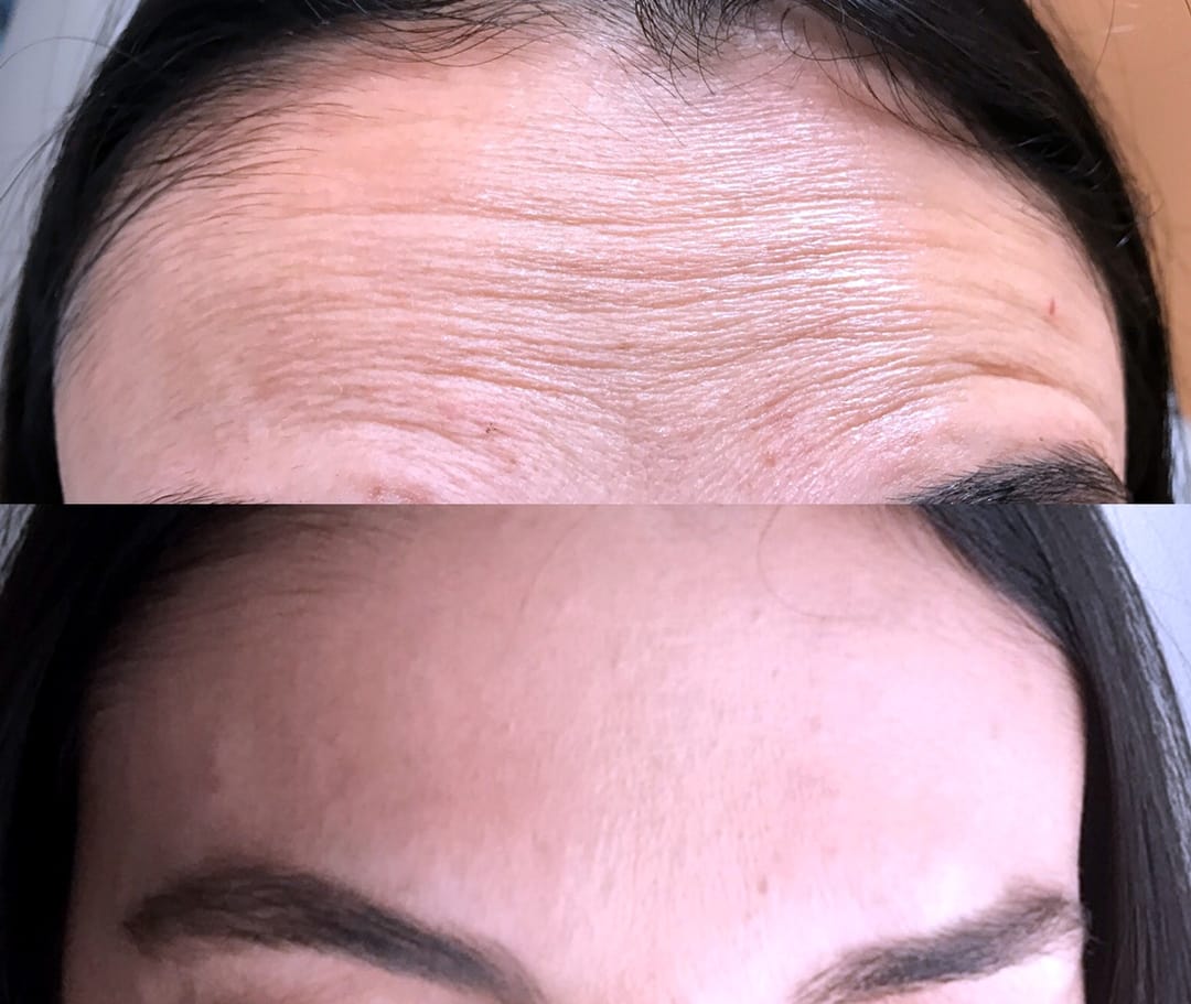 Wrinkle & Line Reduction Before & After Photos Upper East Side New