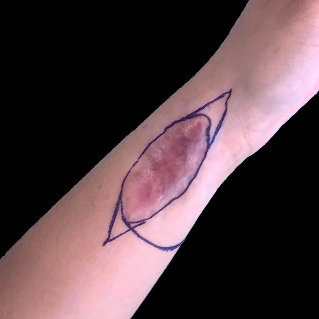 Before & After Photos Scar Revision 16 NYC