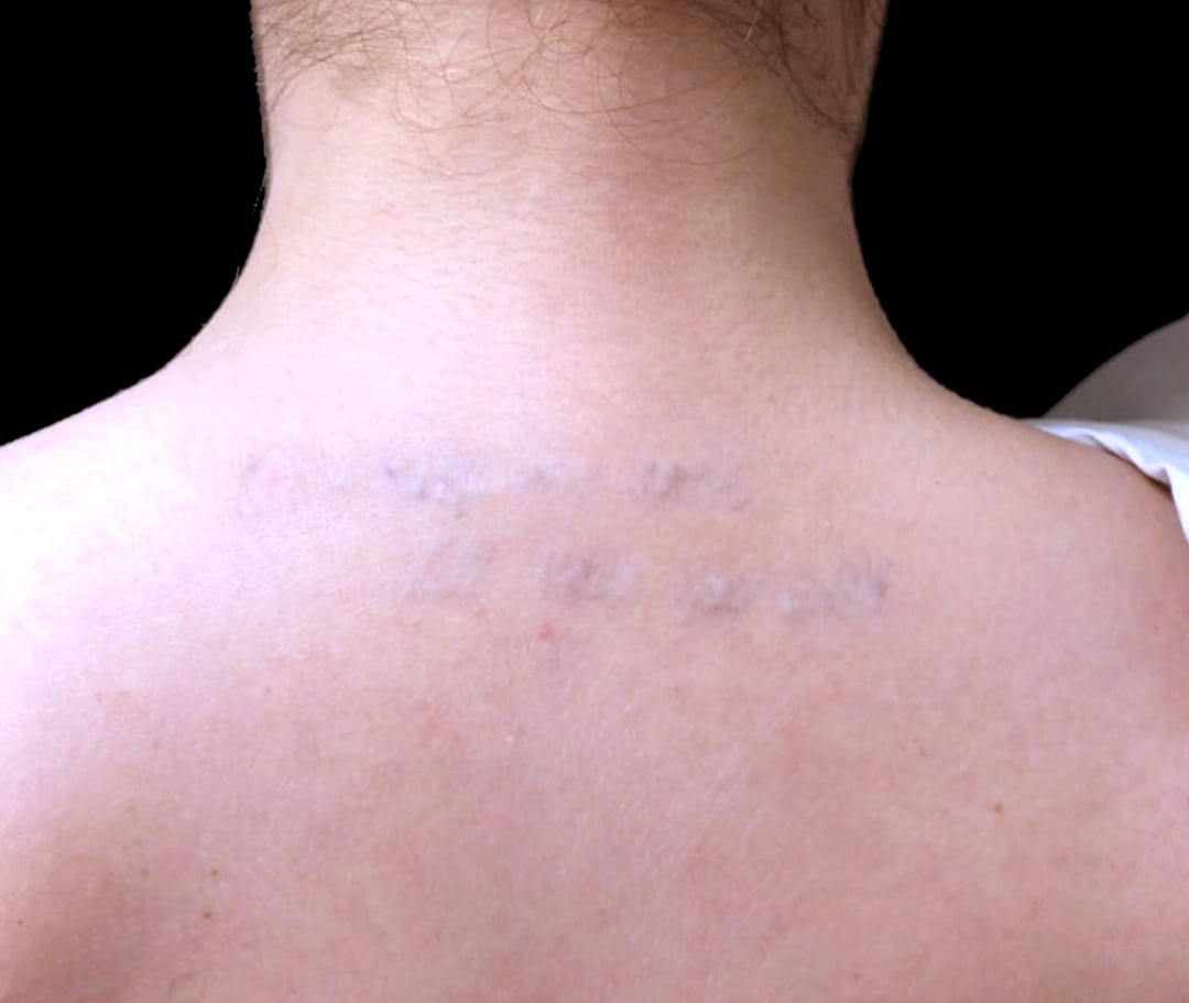 Tattoo Removal 2 Before & After Photos Upper East Side New York, NY