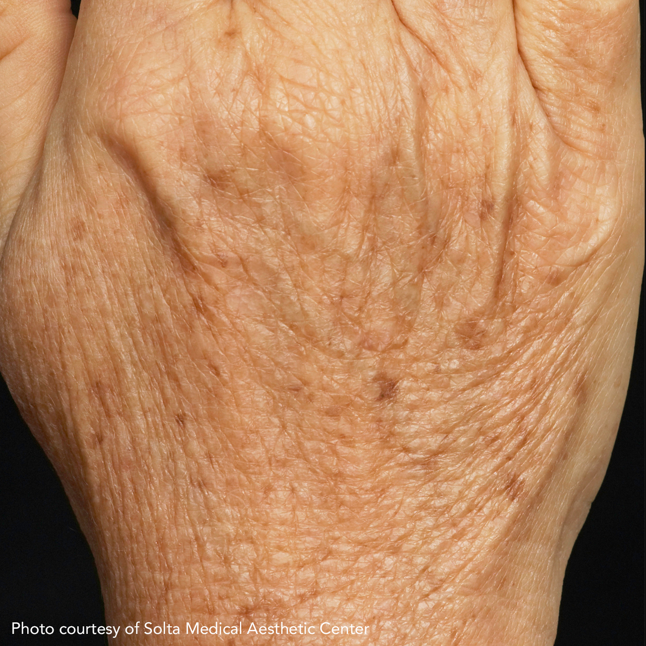 Laser Skin Resurfacing Fraxel 9