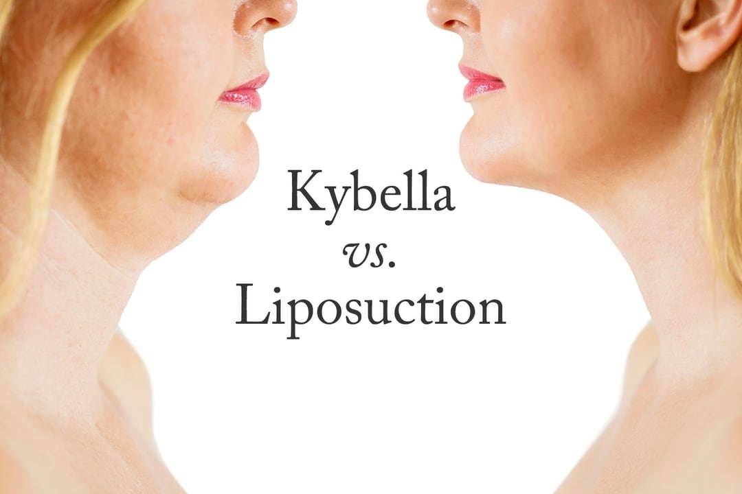Why Use Kybella vs. Liposuction?