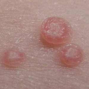 molluscum