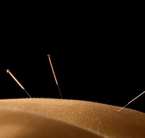 acupuncture medecine douce medecine naturelle aiguille piquer