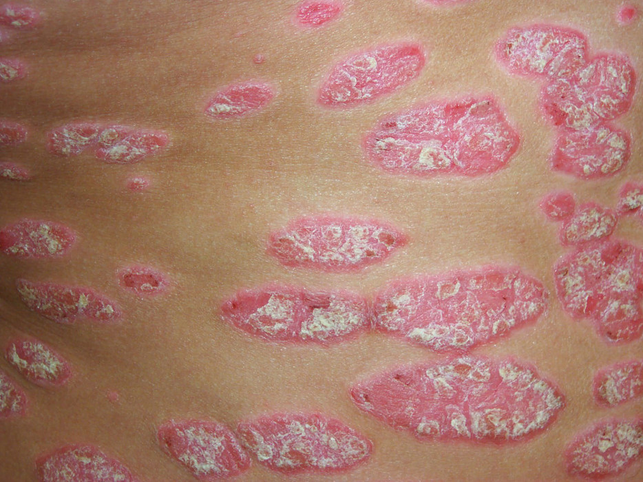 photo d'un psoriasis sur la peau