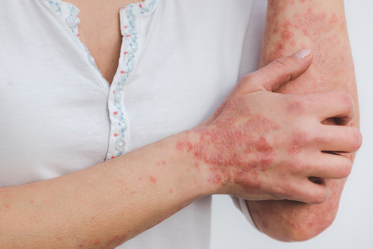 Plaque rouge de psoriasis sur les bras et les mains