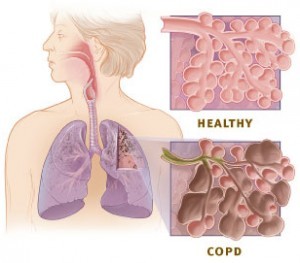 COPD & Asthma diagram