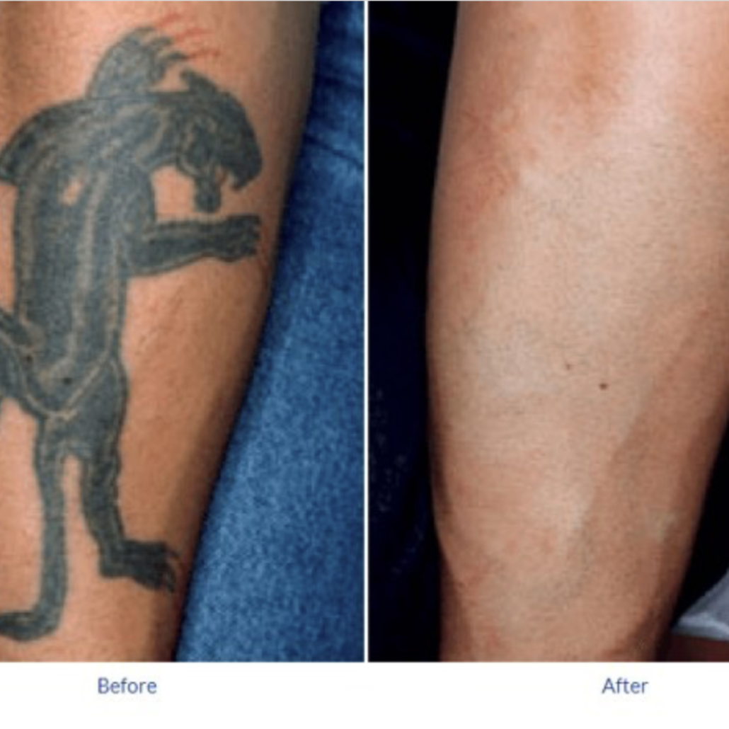 Tatto removal