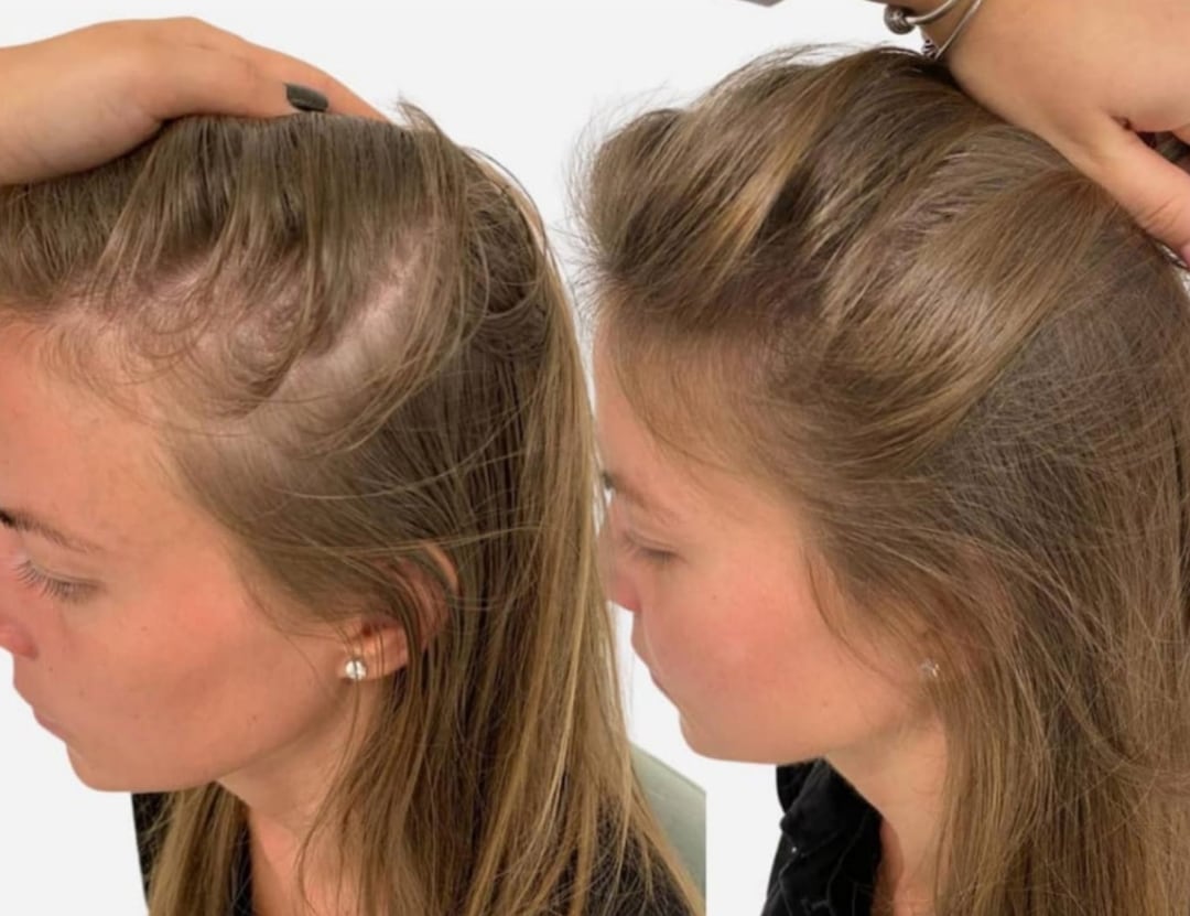 Female FUE Hair Transplant