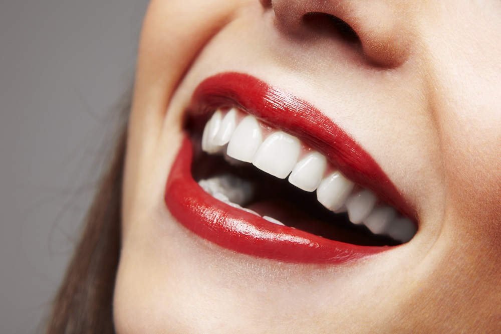 Perfecting Your Smile with Veneers in Madison