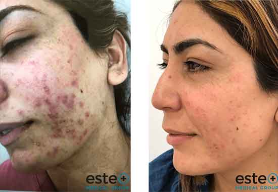 Reduce Acne Scarring with Este Medical Group