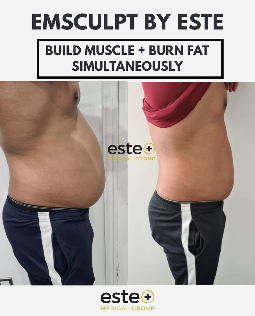 Emsculpt
