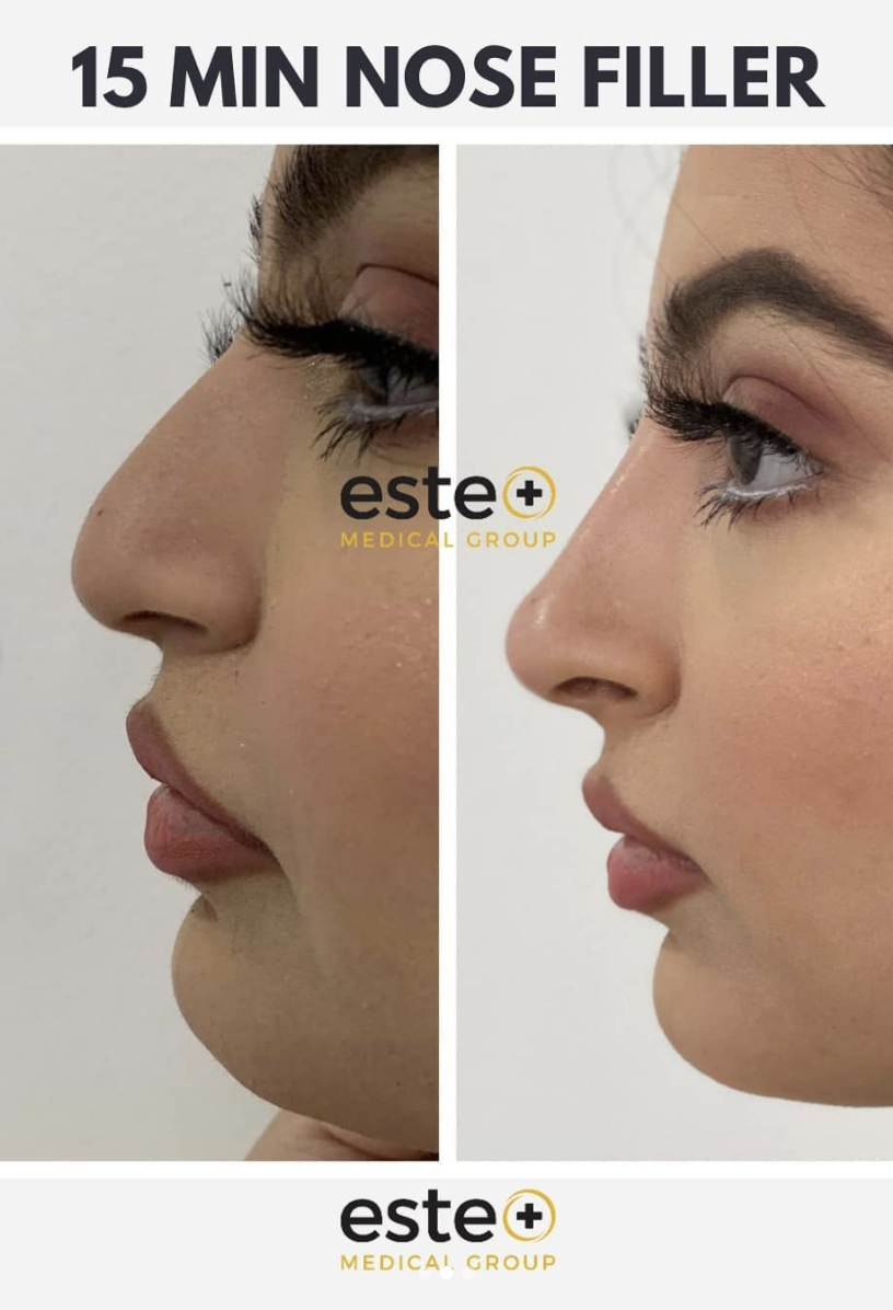 Surgical or Non-Surgical Rhinoplasty?