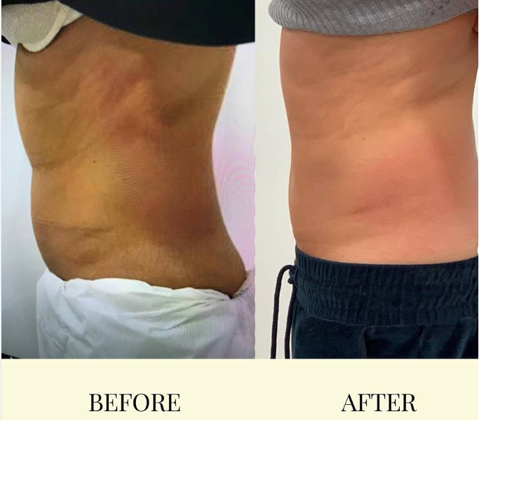 Is fat freezing for me?