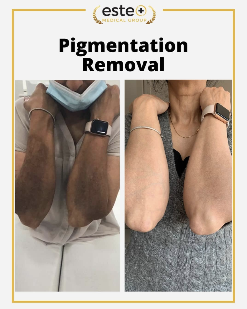 The Ultimate Hyperpigmentation Transformation