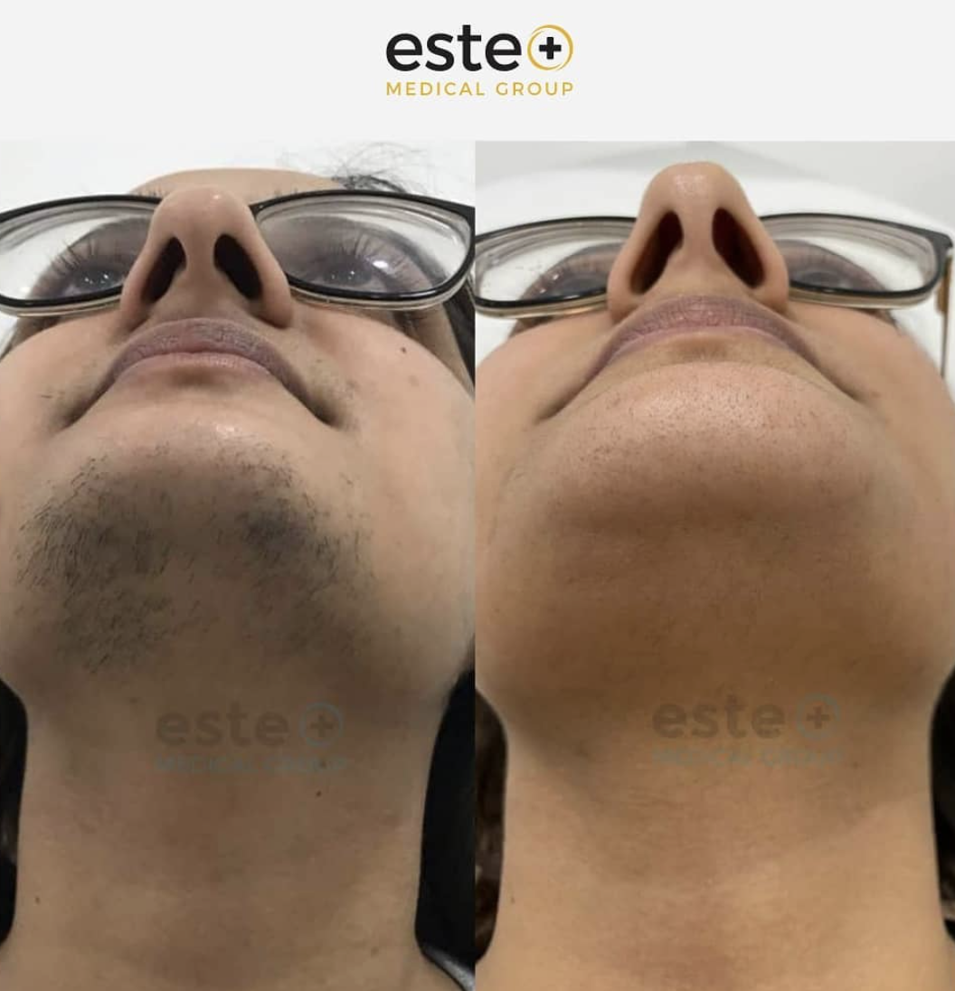 Laser Hair Removal Completely Changed Her Life