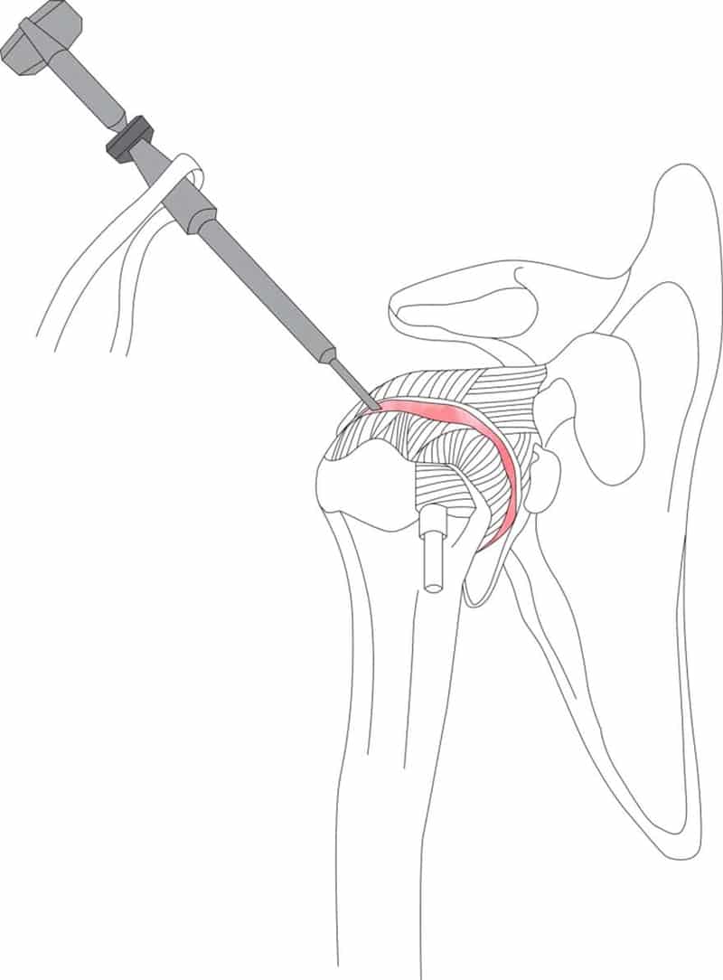 Frozen Shoulder Arthroscopic Release Shoulder Clinic