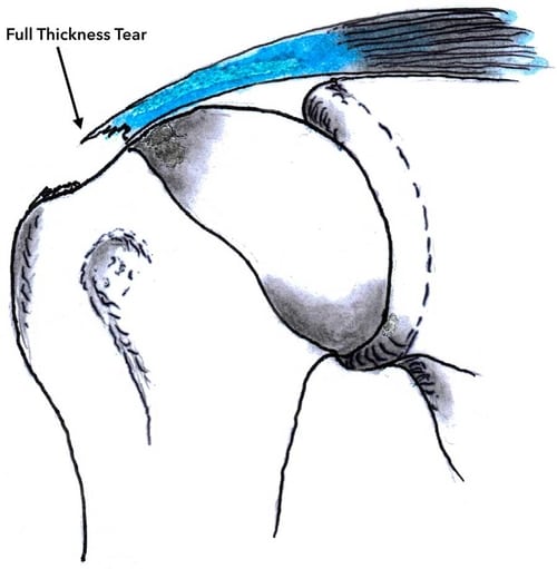 Rotator Cuff Tear Shoulder Clinic