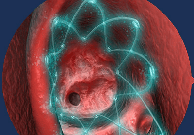 PROPEL delivers medicine directly to your sinuses