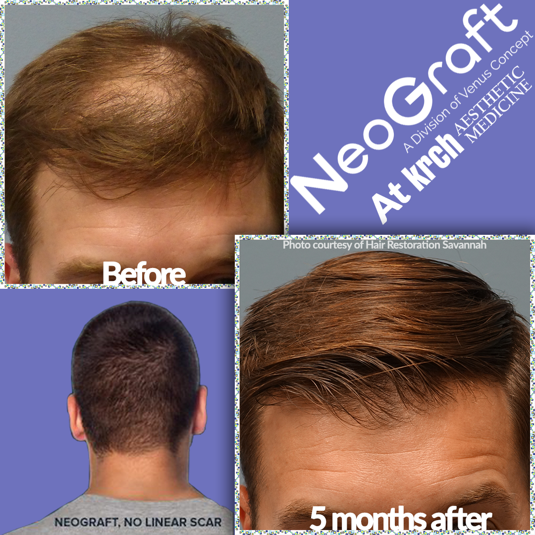 20% off Neograft