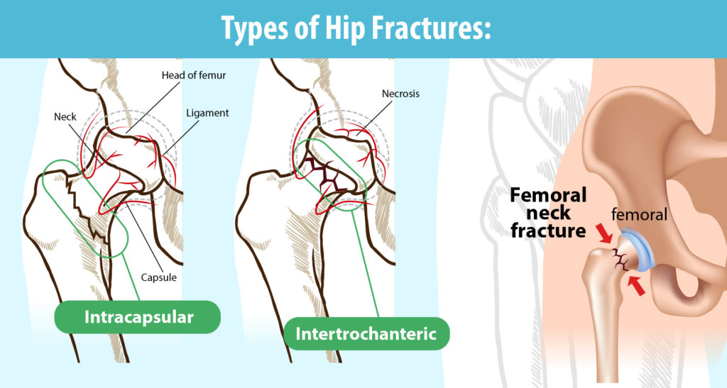 Types of hip fractures