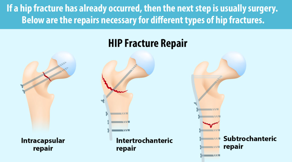 Hip fracture repair