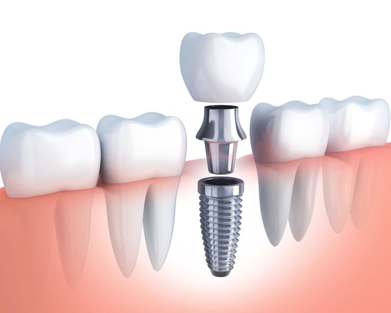Dental Implants Jacksonville, FL JAX Dental Studio