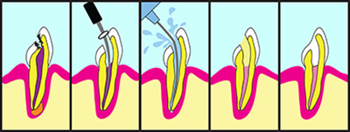 Root Therapy