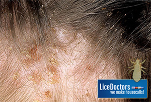 conroe severe head lice scab itching