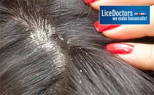 close image of dandruff in dark brown hair LiceDoctors image